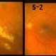 Lymphoma Acute Retinal Necrosis (ARN)